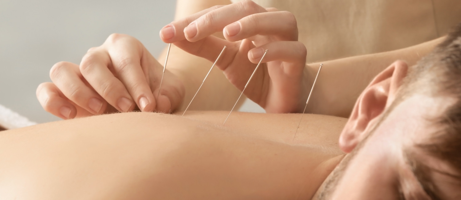 young man acupuncture treatment